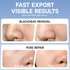 TrySafe extraction scraper and tools beside pads, helps controlled blackhead removal