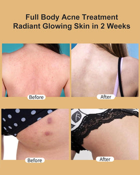 TTLALA being applied to buttocks demonstrating soothing relief and quick absorption