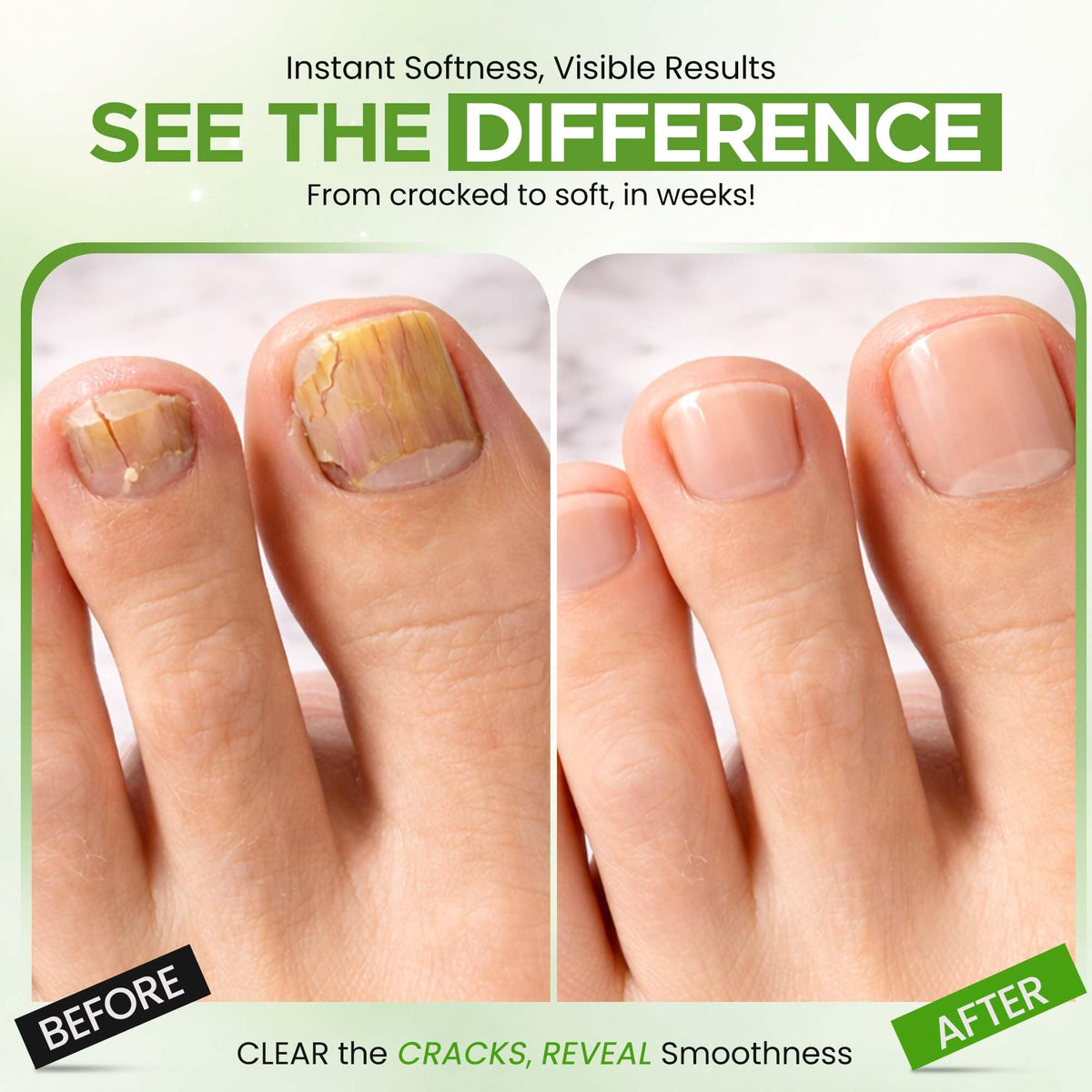 TXLSC CLEAR gel applied to toenail illustrating targeted nightly care