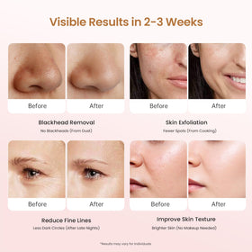 UNOISETION device in use on nose extracting blackheads effectively