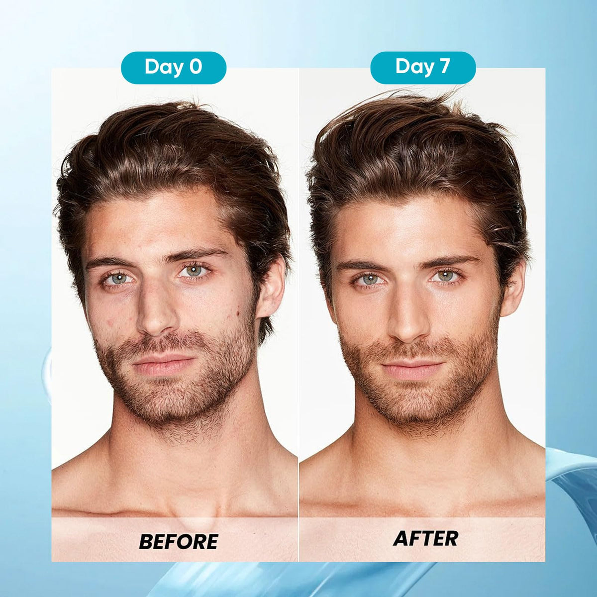 Vbolre Calvris being applied to scalp demonstrating cooling relief and non-greasy finish
