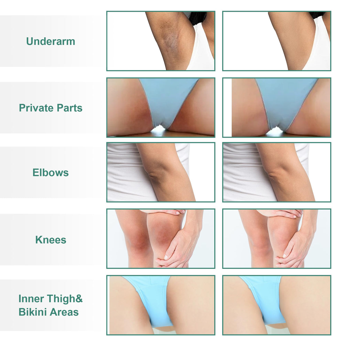 Vcetree being applied underarm showing targeted tone improvement