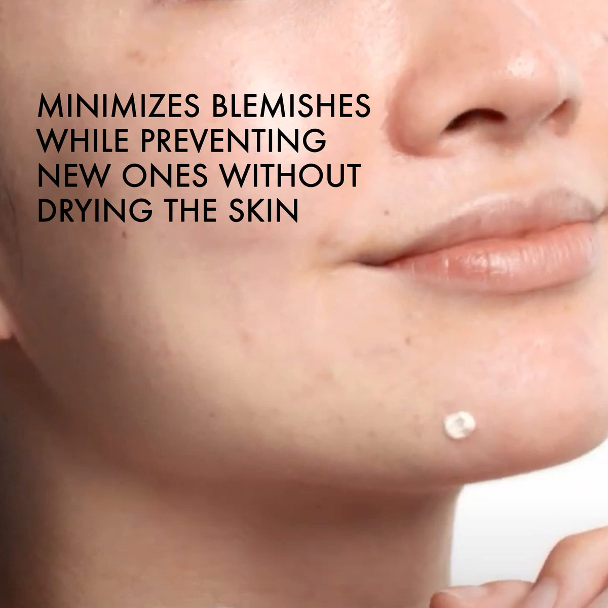 Vichy product being applied to a blemish, reducing redness and swelling