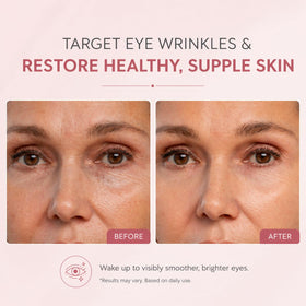 Vitalore after treatment showing smoother, hydrated under-eye area