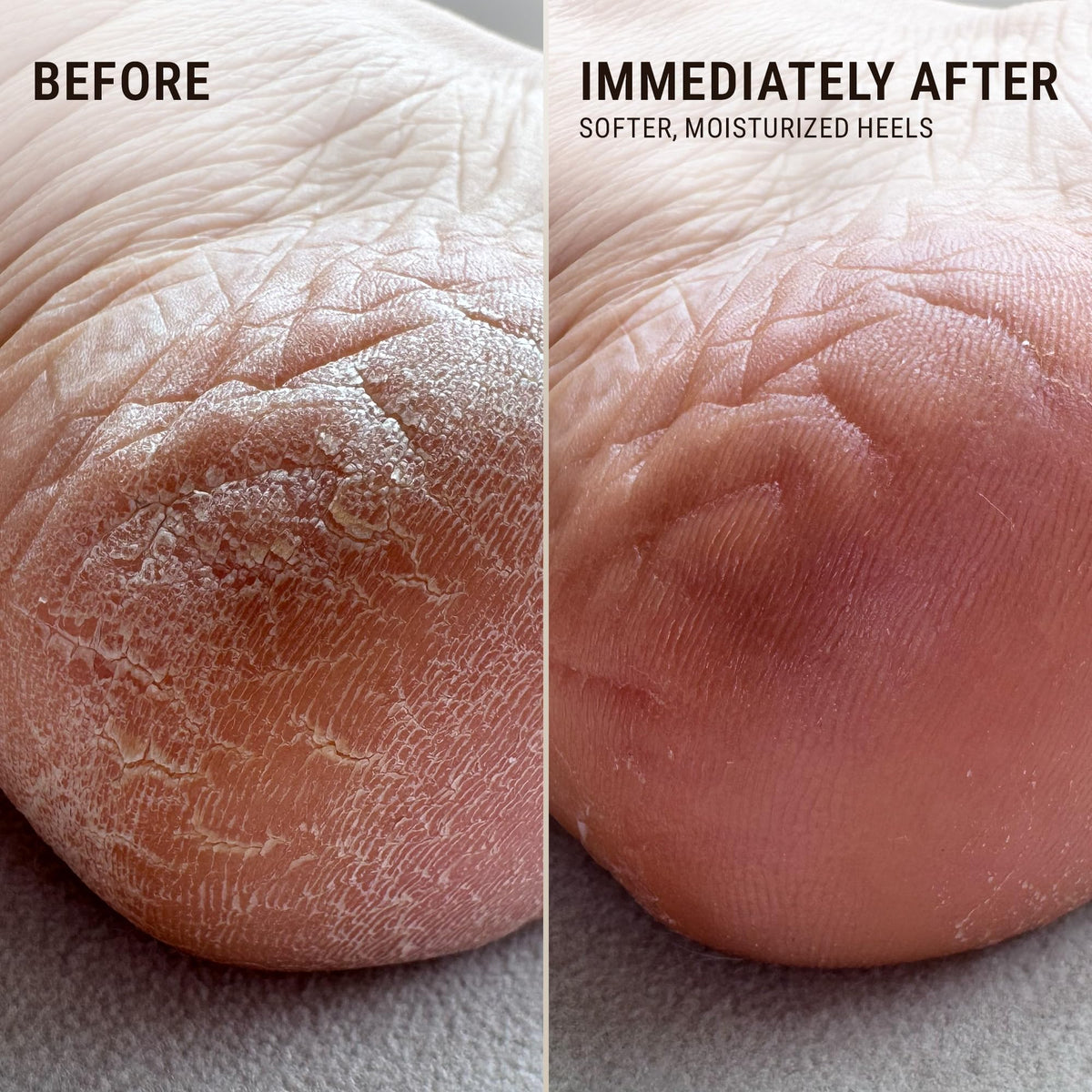 VOESH being applied to a heel for targeted moisturization and repair