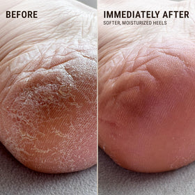 VOESH being applied to a heel for targeted moisturization and repair