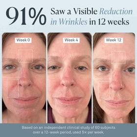 VogueNow profile showing extended chin coverage improving jawline exposure