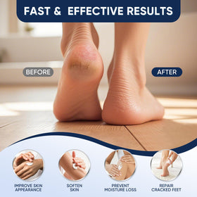 VREKEF being applied to heel to soften callus and hydrate dry skin