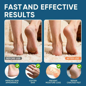 VREKEF application on heel demonstrating callus softening benefit