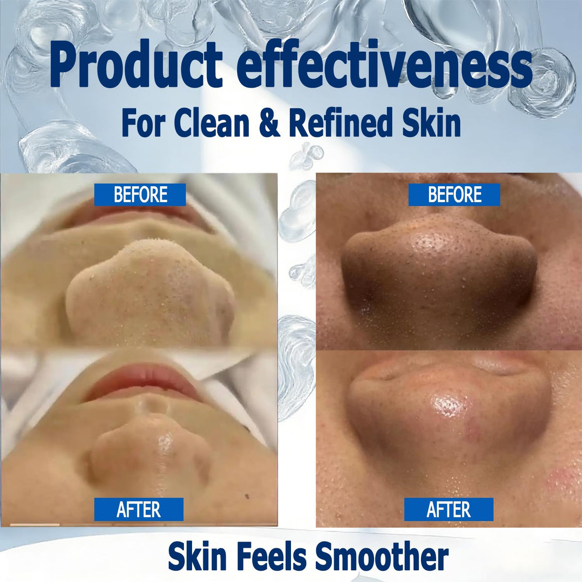 Vue Swiss patch applied to nose demonstrating comfortable fit and removal ease