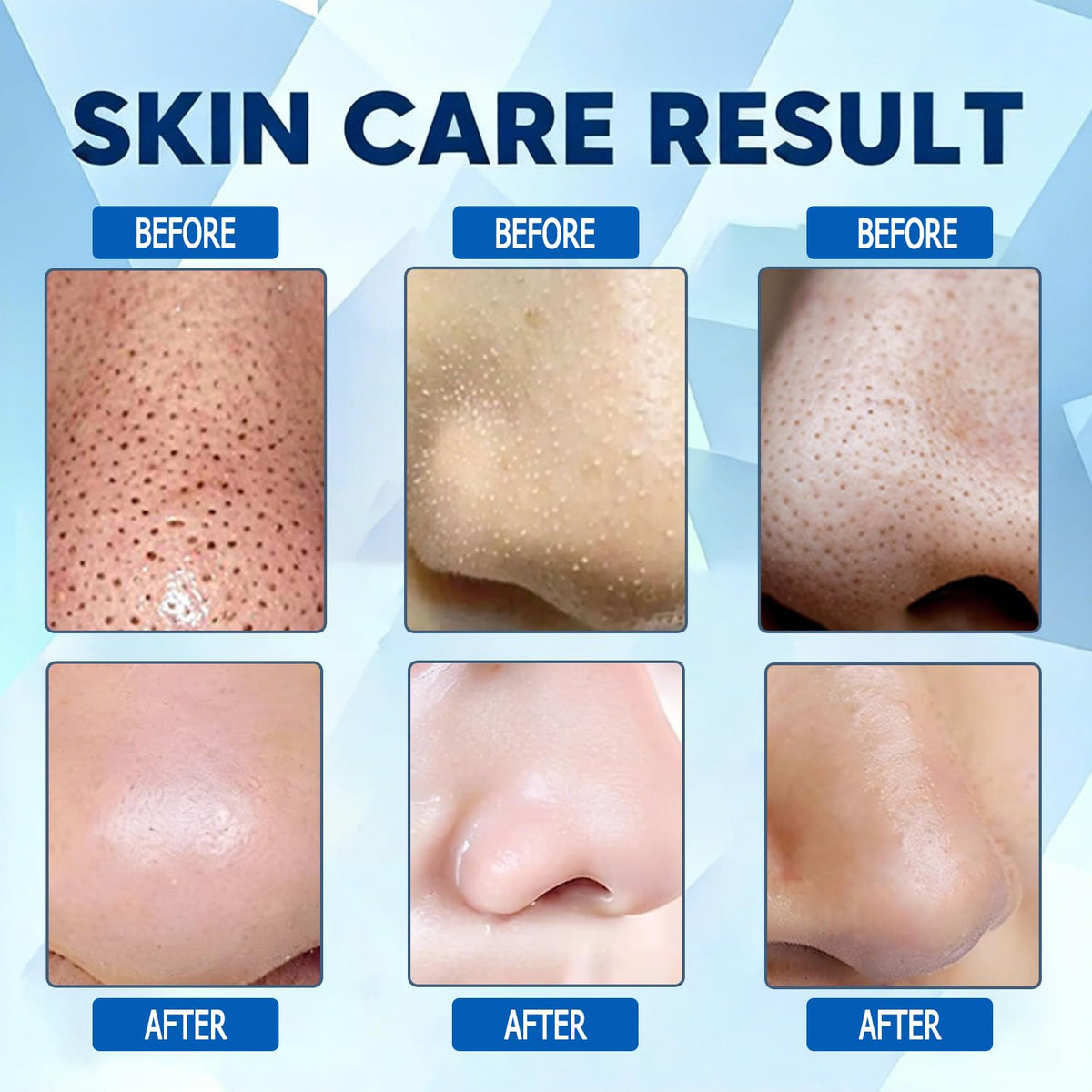 Vue Swiss close-up of hydrocolloid patch texture highlighting gentle adhesion