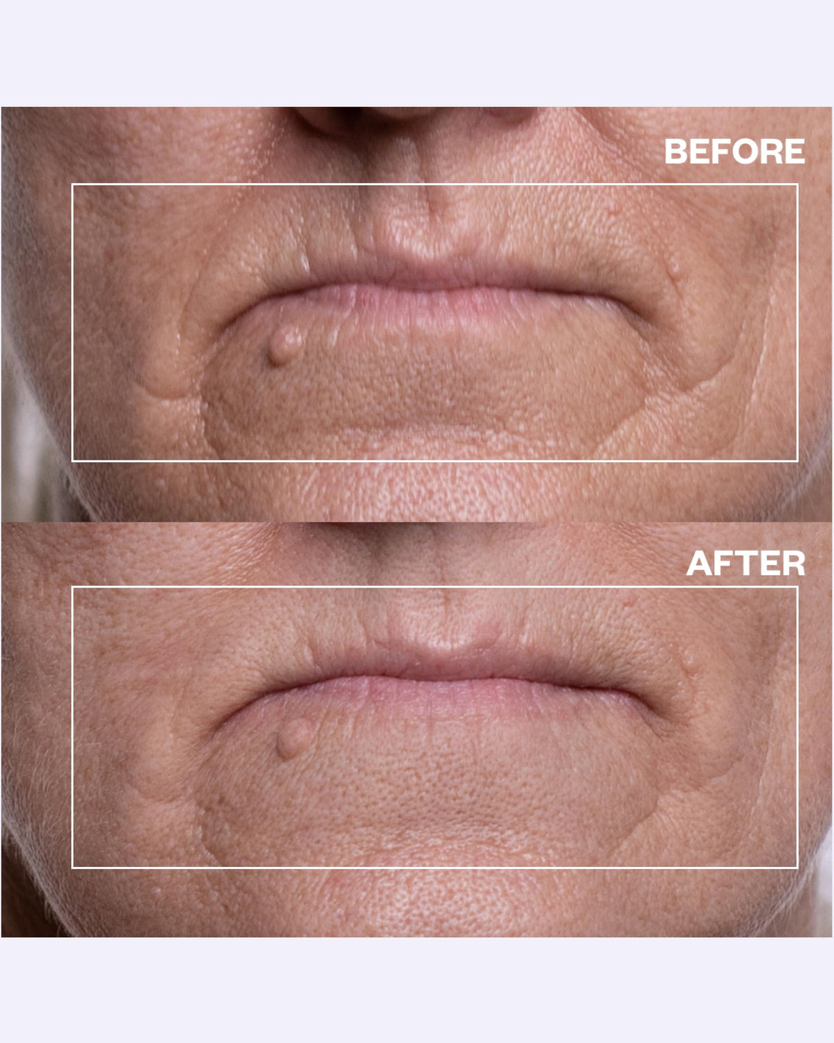 Wrinkles Schminkles patch applied above lips demonstrating crease prevention
