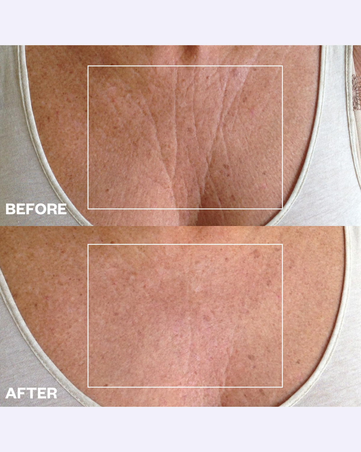 Wrinkles Schminkles patch applied to chest showing discreet coverage and comfort