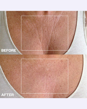 Wrinkles Schminkles patch applied to chest showing discreet coverage and comfort