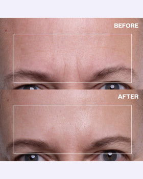 Wrinkles Schminkles patch applied to forehead demonstrating discreet wear