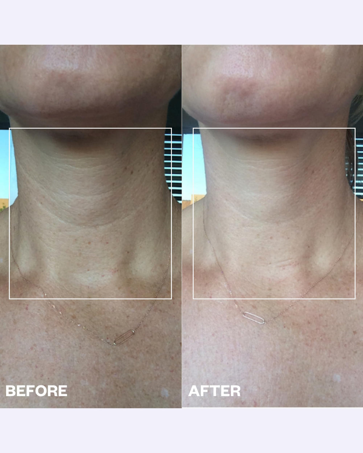 Wrinkles Schminkles patch applied to neck demonstrating smoothing effect during wear