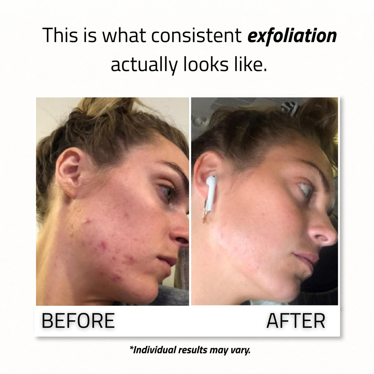 YEOUTH being applied to clean skin demonstrating safe at-home use