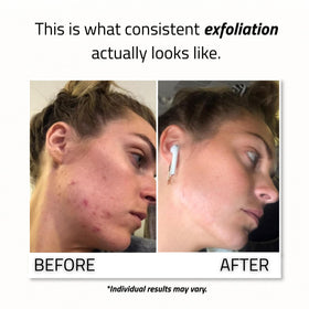 YEOUTH being applied to clean skin demonstrating safe at-home use
