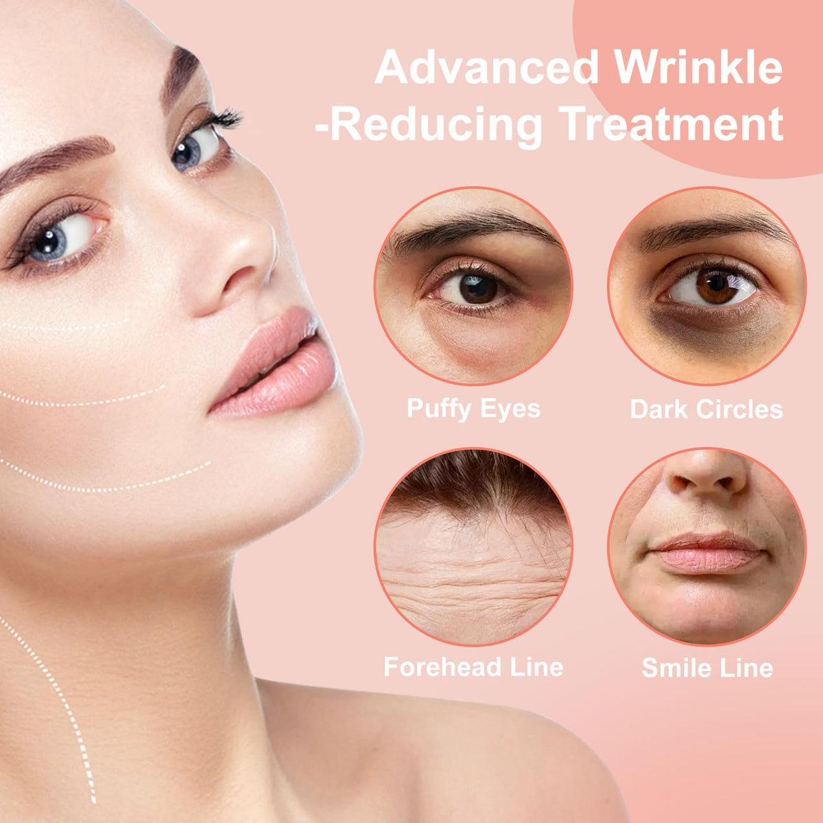 YLOTRE patches placed on forehead and smile lines showing multi-area use