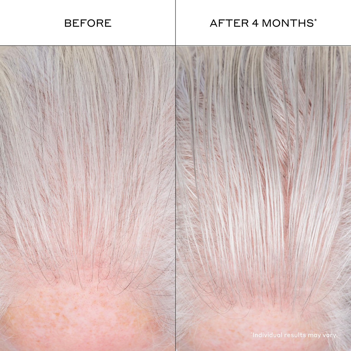 Zenagen in-use by model styling hair for natural-looking density
