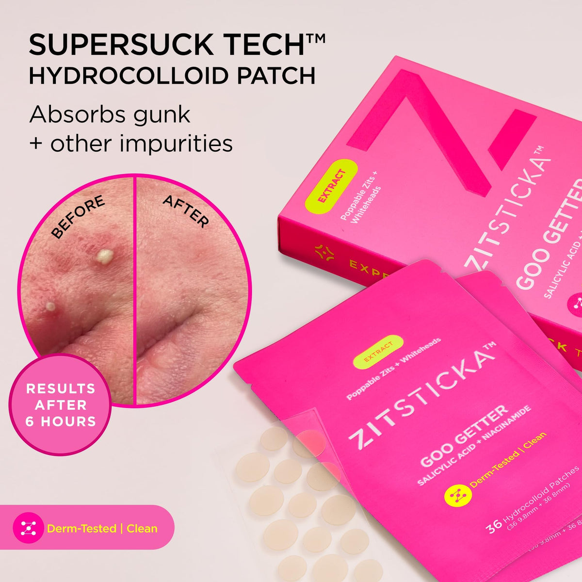 ZitSticka body patch on shoulder offering discreet coverage