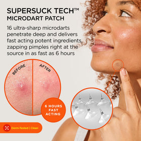 ZitSticka close-up of a clear mini patch highlighting discreet coverage and adhesion