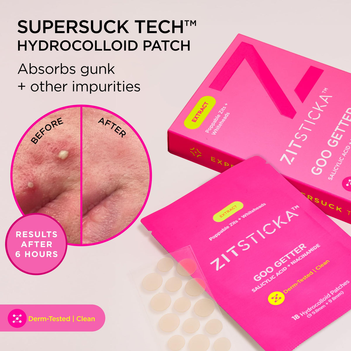 ZitSticka patch on upper back showing body blemish protection benefit