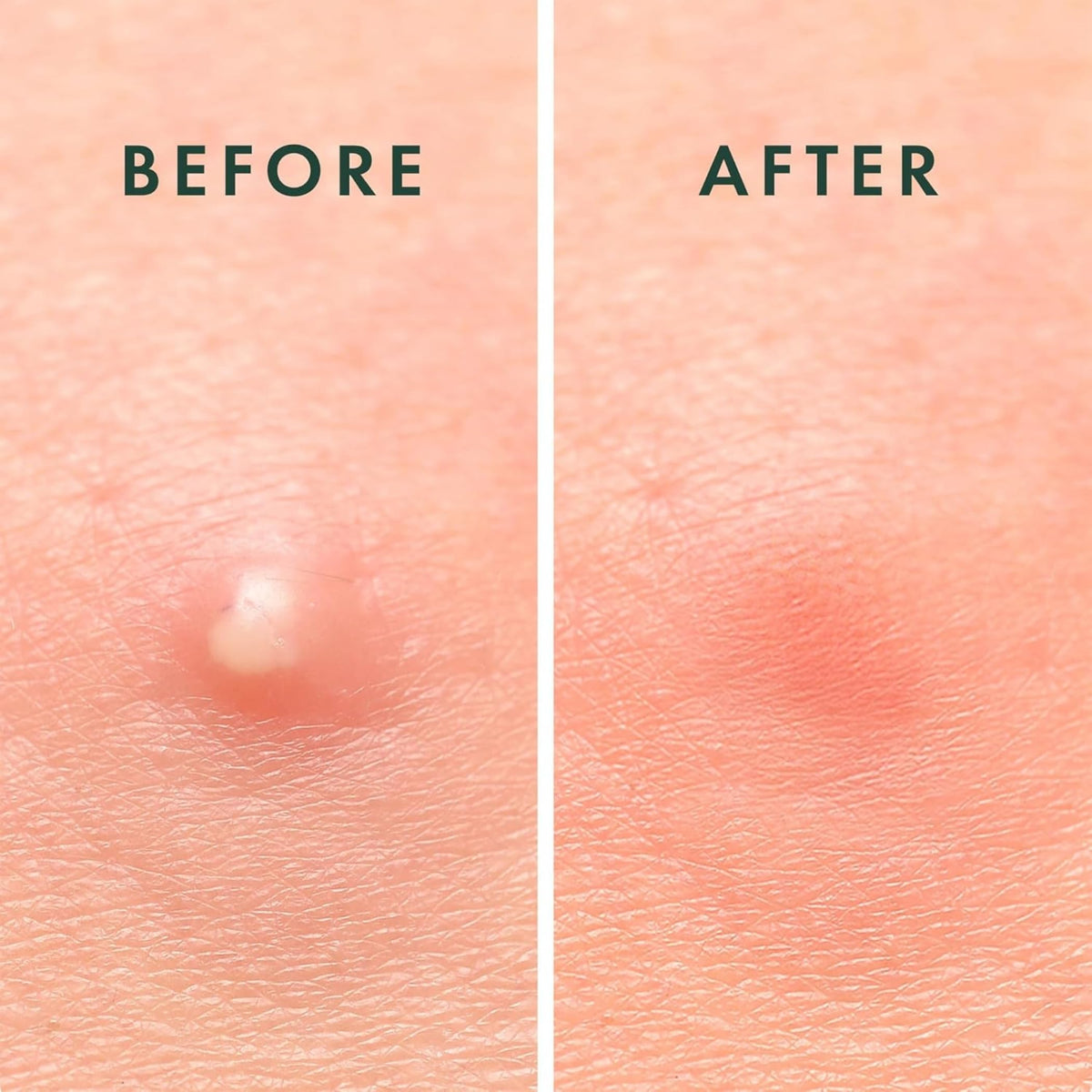 ZOVIRA multiple patches on forehead showing coverage for several spots