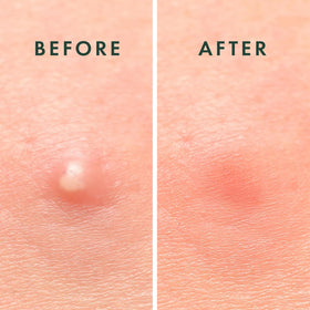 ZOVIRA multiple patches on forehead showing coverage for several spots
