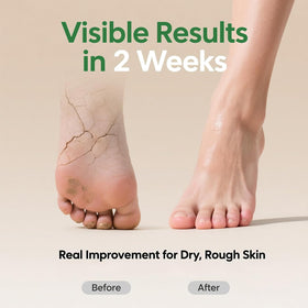ZyraGloz applied on heel showing softening benefit